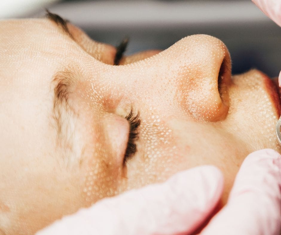 Trattamenti Laser Laser co2 frazionato